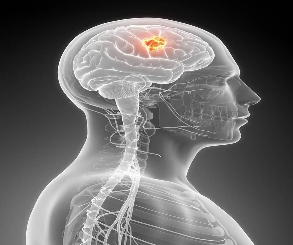 Long-term cell phone use increases brain tumor risk