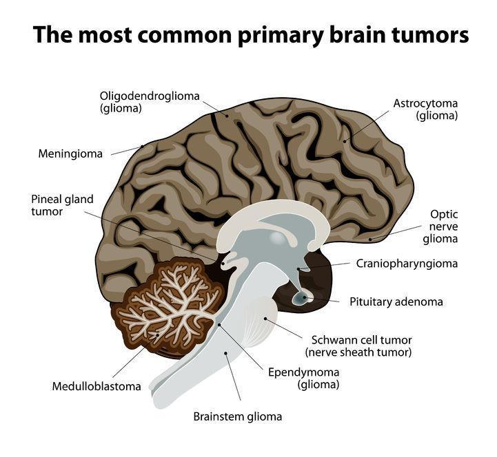 The Incidence of Meningioma, a Non-Malignant Brain Tumor, is Increasing in the U.S.