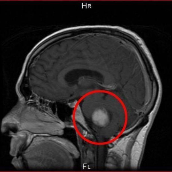 Fifth Court in Italy Ruled Cell Phones Cause Brain Tumors and Determined It Is An Occupational Disease