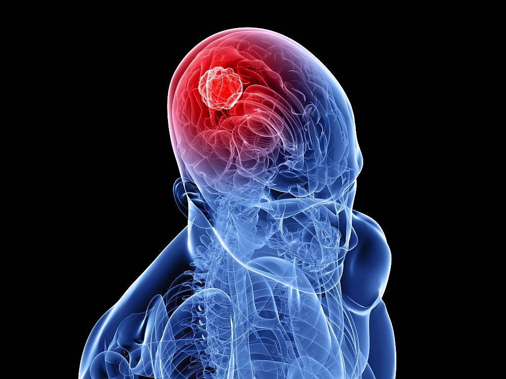 Study: Cellphone Use ‘Triples Brain Tumor Rates’