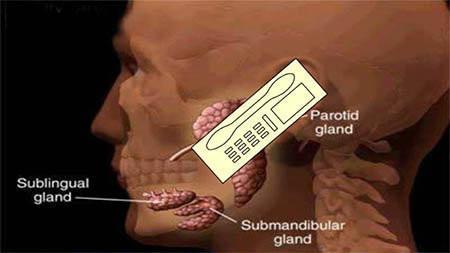 Cell Phone Use and Salivary Gland Tumor Risk